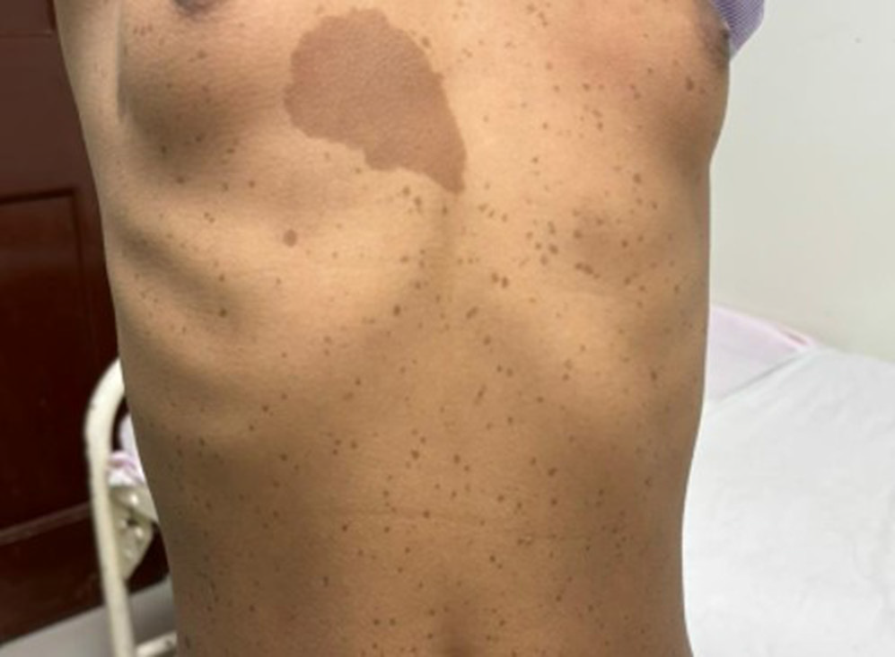Pediatric genitourinary plexiform neurofibroma in a case of neurofibromatosis type 1