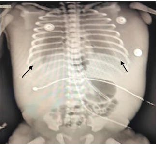 A rare case of conservatively managed congenital chylothorax presenting as hydrops fetalis