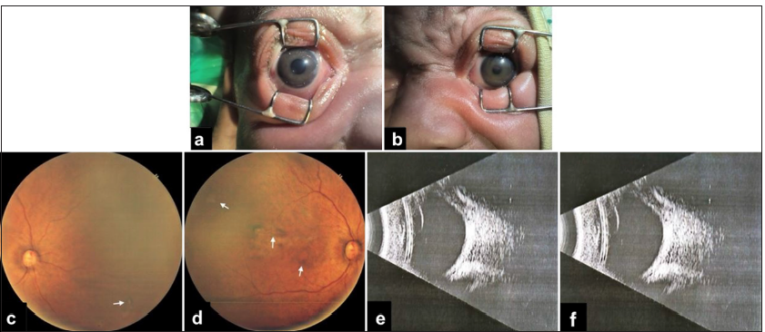 Anisocoria in a neonatal intensive care unit: An ophthalmological emergency?