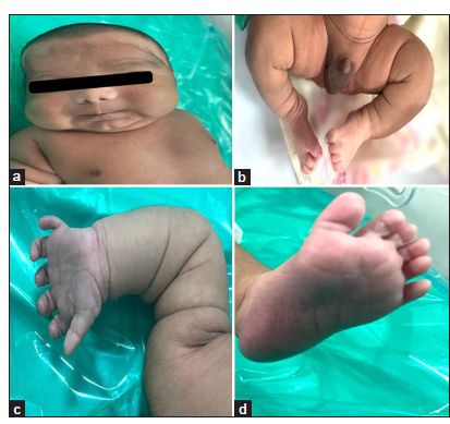 A rare syndrome diagnosed in a LGA neonate!!!