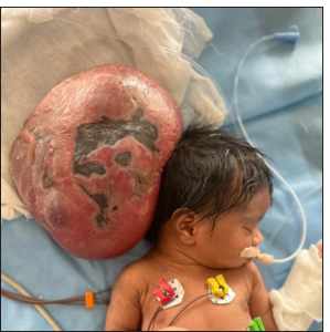 Giant occipital encephalocele in a neonate undergoing successful neurosurgical intervention