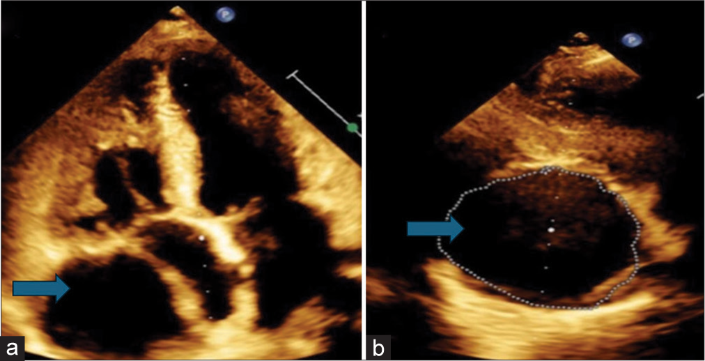 Right Coronary Artery Aneurysm Masquerading as a Pericardial Cyst: A Case Report