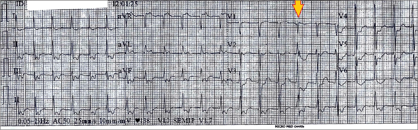 Revisiting Supraventricular Tachycardia Maneuvers: A Pictorial Brief for the Budding Electrophysiologists