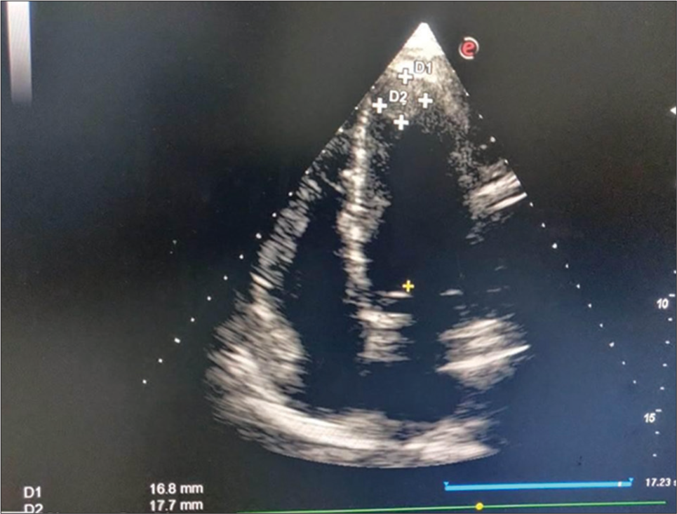 To Compare the Efficacy of Rivaroxaban with Nicoumolone in the Management of Patients with Intraventricular Thrombus