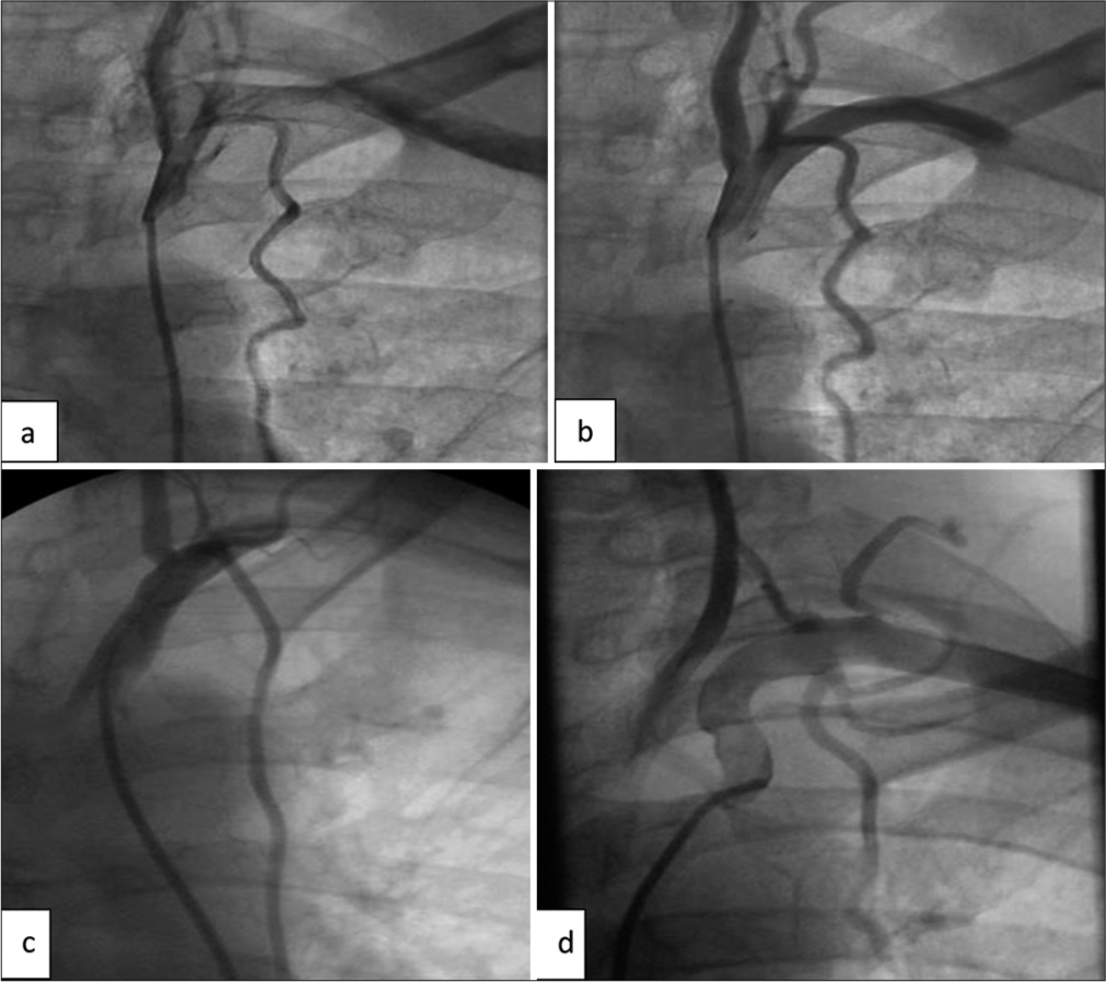 Observational Angiographic Study of the Anatomical Variations of the Left Internal Mammary Artery and its Surgical Significance