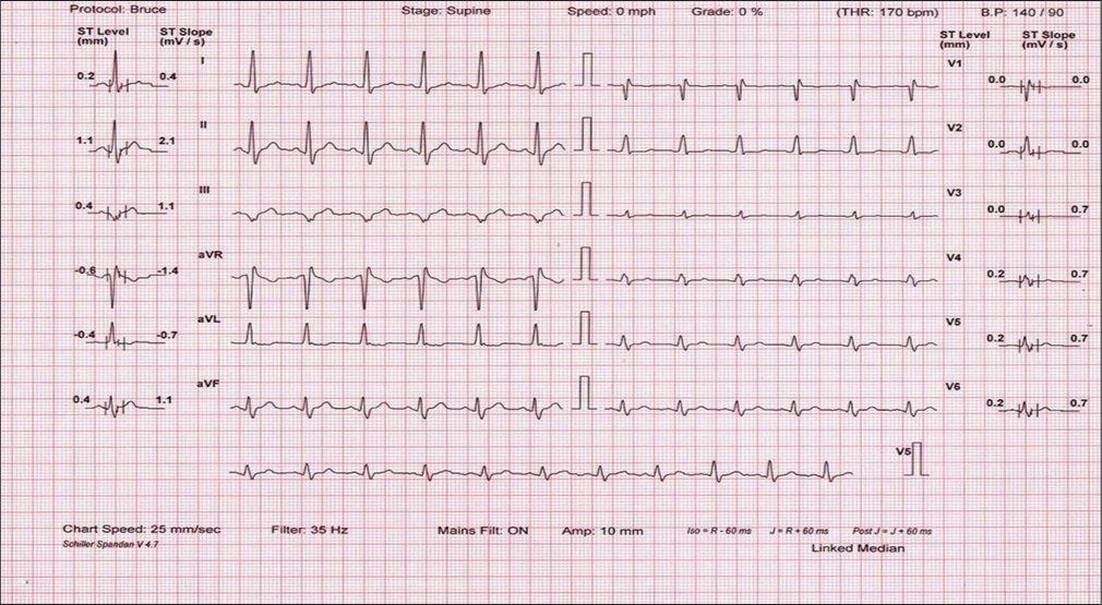 Exercise-induced Brugada Type I Pattern of ECG in an Asymptomatic Adult