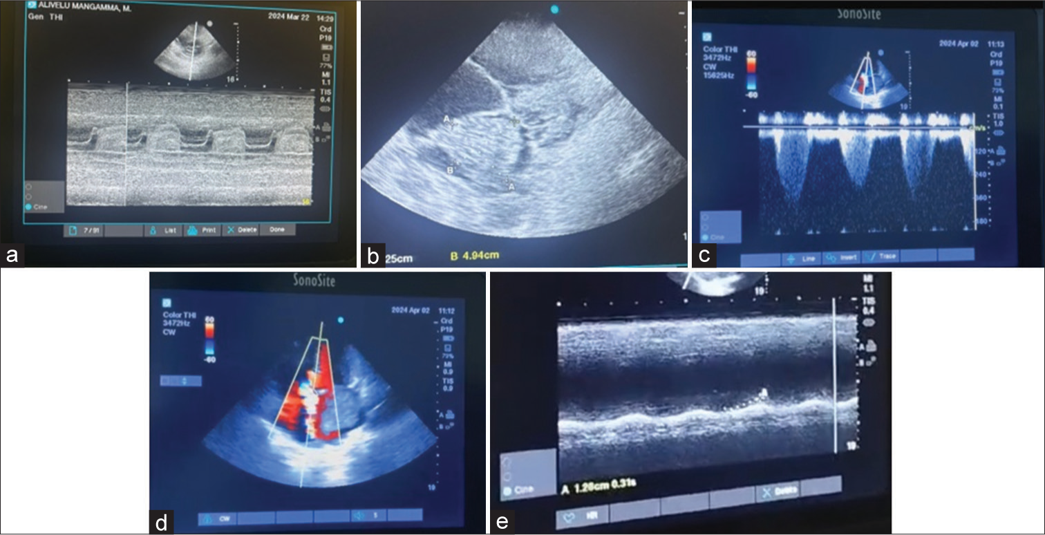 A Rare Cause of Right Heart Failure