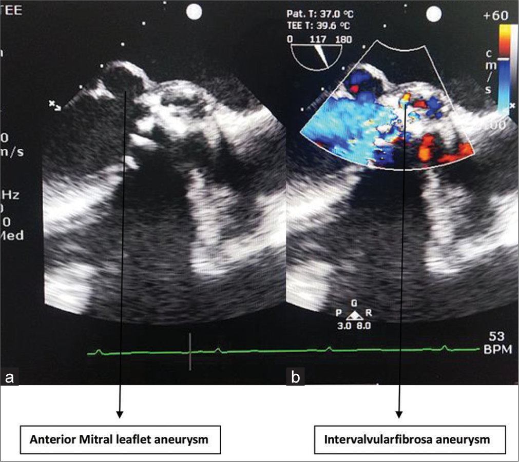 Iatrogenic Pseudoaneurysm of Intervalvular Fibrosa – A Case Report