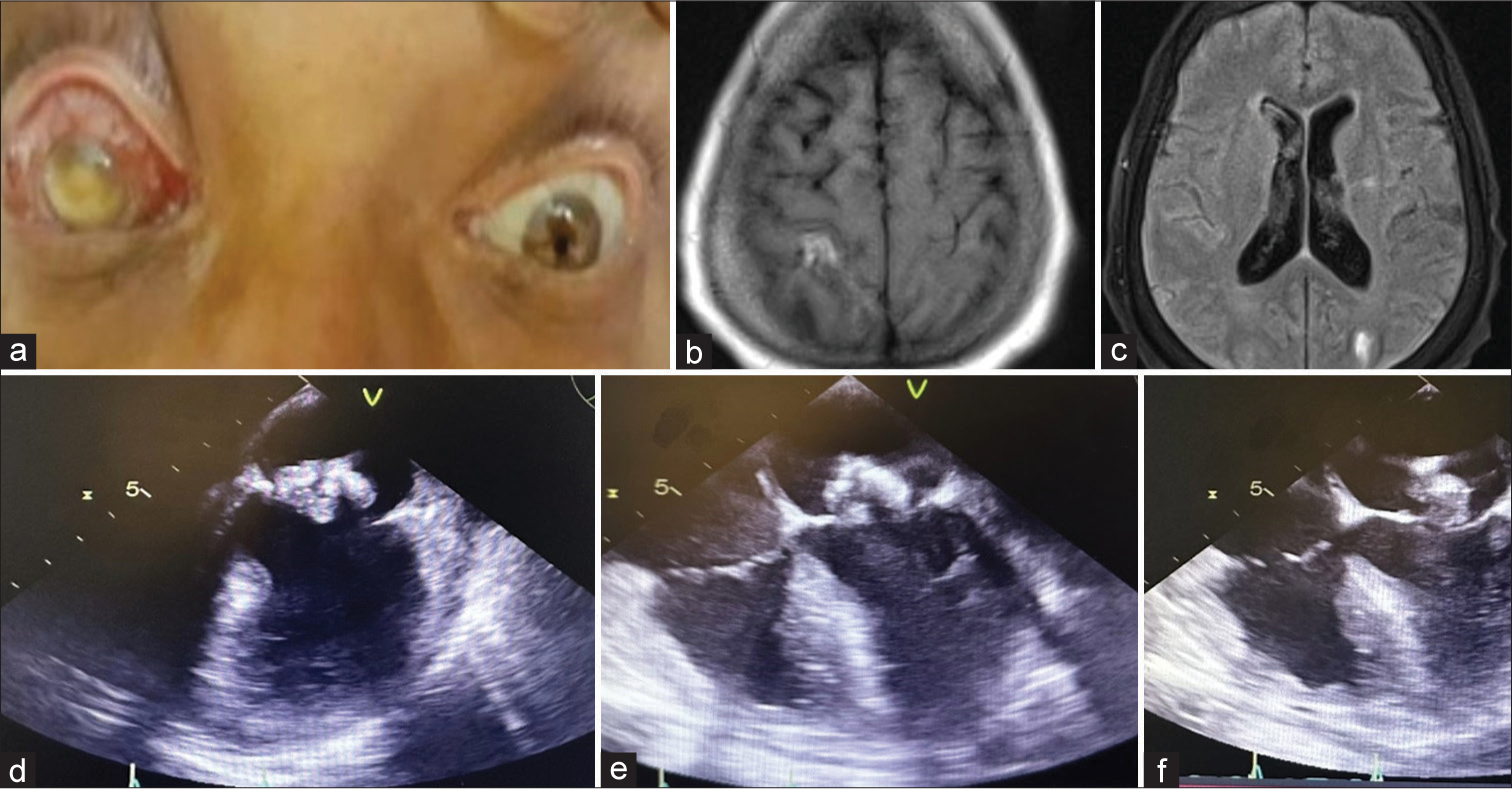 Infective Endocarditis Presenting as Endogenous Endophthalmitis and Multiple Cerebral Infarcts