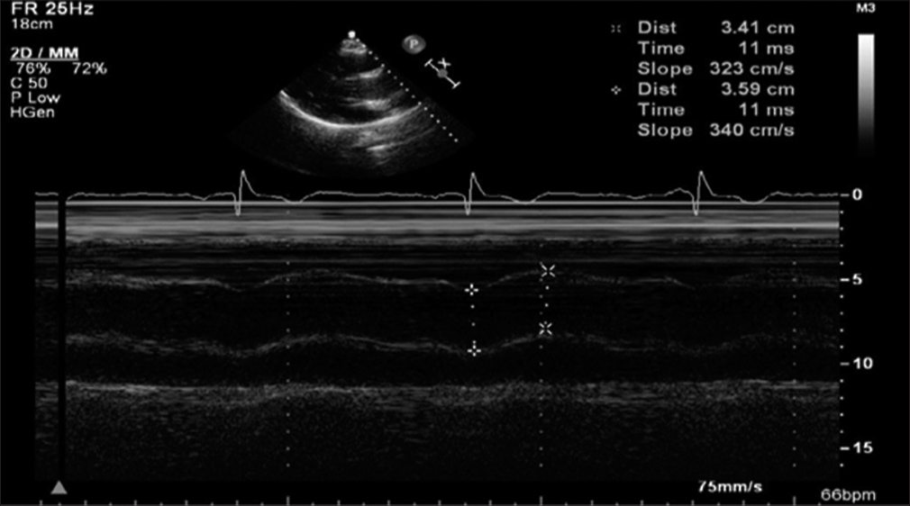 Role of Echocardiographic Aortic Propagation Velocity in Predicting Obstructive Coronary Artery Disease – A Prospective Observational Study