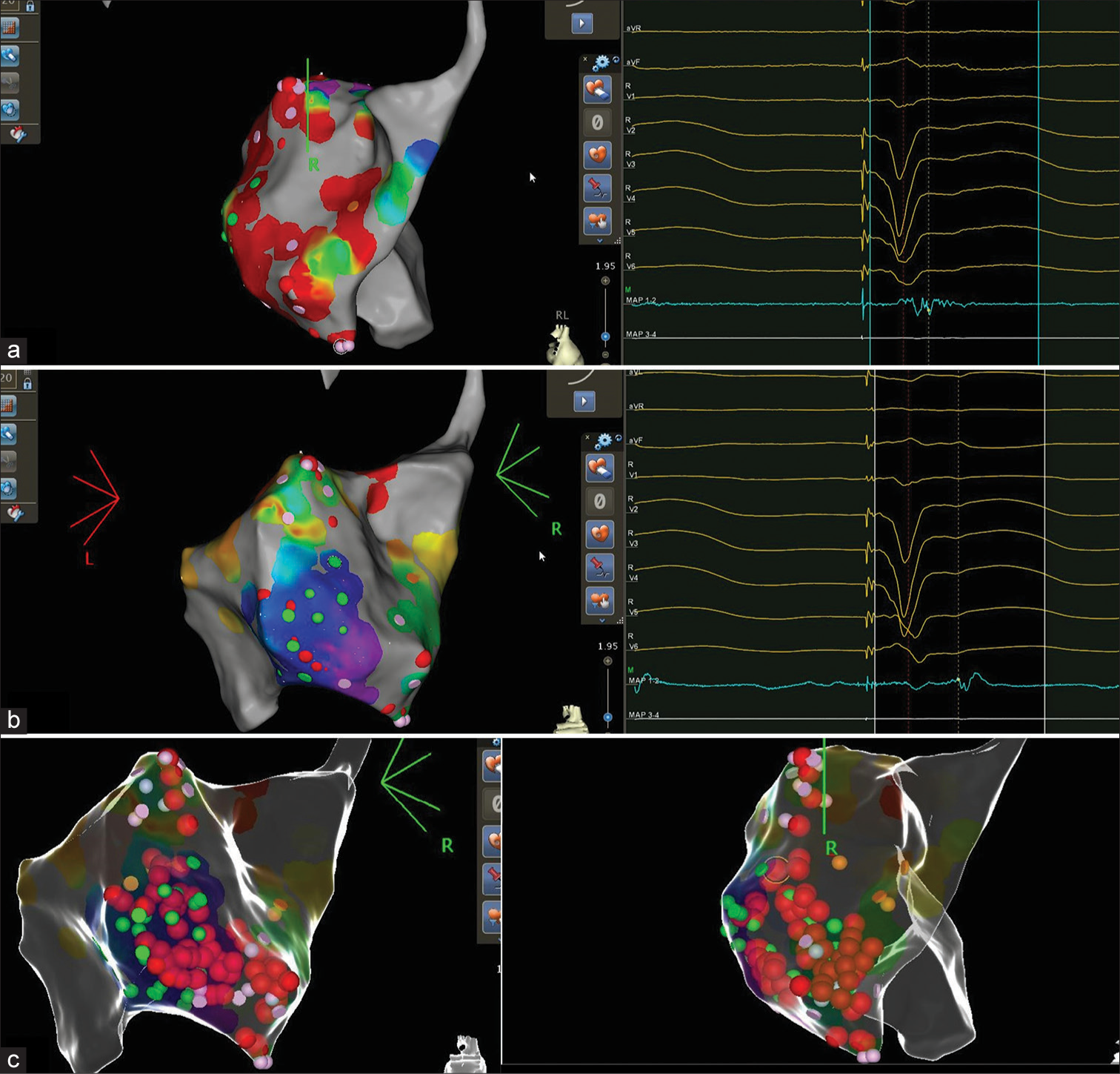 Substrate Modification of Ischemic Scar in the Left Ventricle