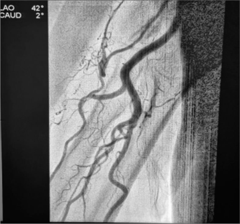 Percutaneous Transulnar Arterial Approach for Coronary Interventions