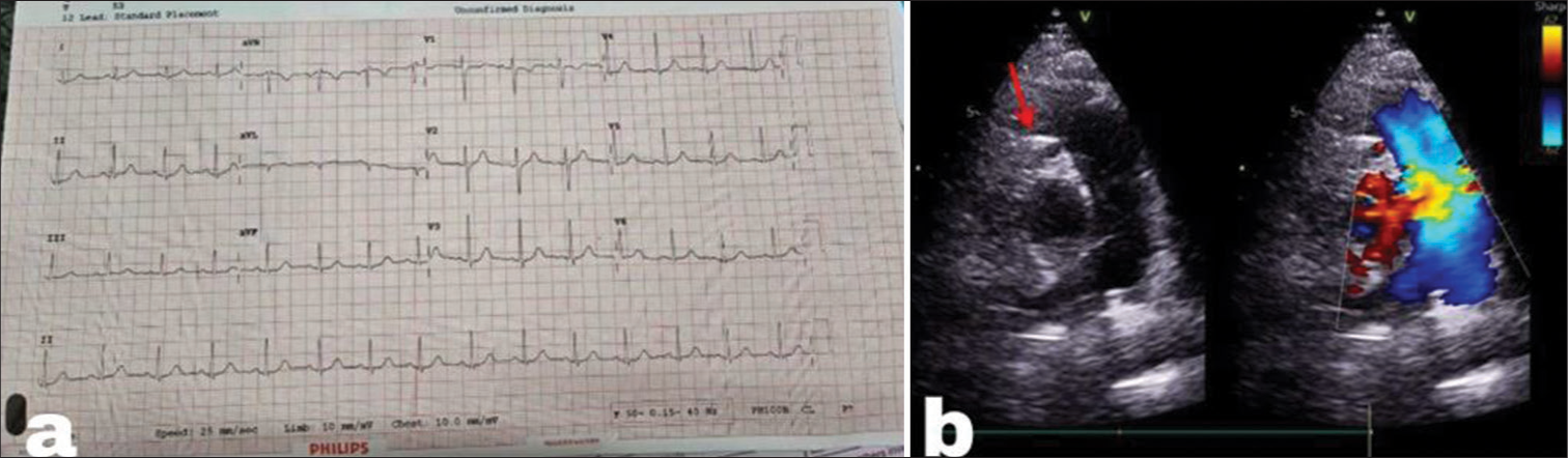 Silent Intruder: Unveiling Asymptomatic Anomalous Left Coronary Artery in Adulthood