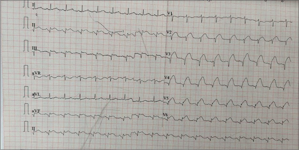 Acute Anterior Wall Myocardial Infarction in a Gallbladder Cancer Patient: A Case of Sudden Coronary Thrombosis Post-normal Angiogram