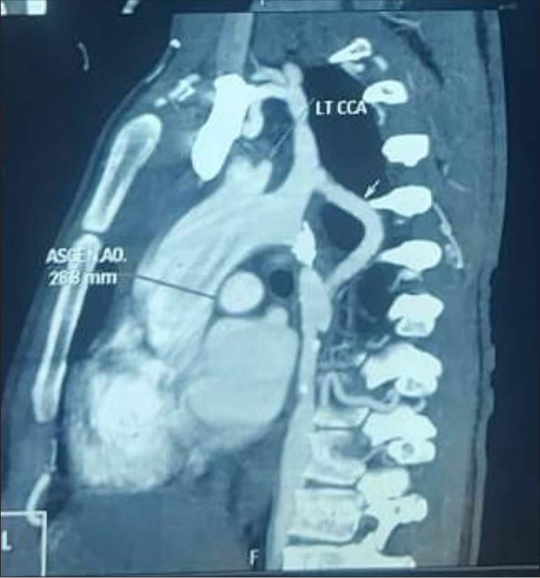 A Young Pregnant Woman with Aortic Coarctation and Hypertrophic Cardiomyopathy
