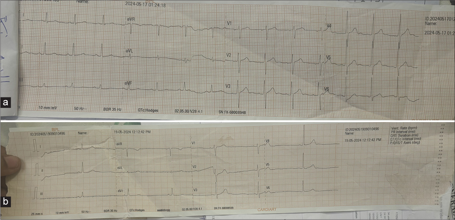 Electrocardiographic Manifestations of Yellow Oleander Poisoning in Patients Treated at a Tertiary Care Centre
