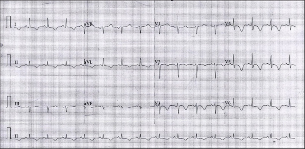 Pheochromocytoma Masquerading as Acute Coronary Syndrome and Takotsubo Cardiomyopathy: A Diagnostic Dilemma in the Elderly