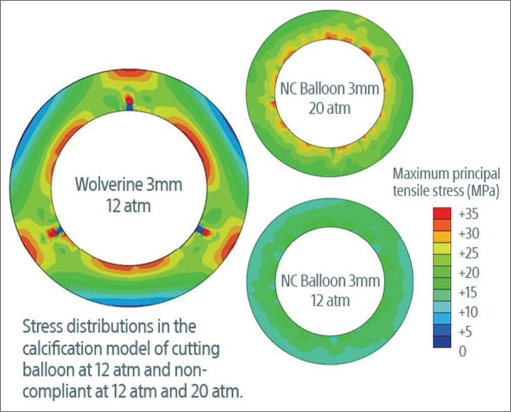 Coronary Balloons of 2024 and Future