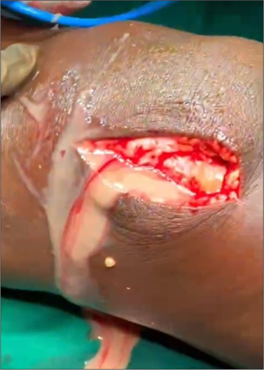 Corynebacterium diphtheriae - Uncustomary Avatar in a Patient with Prosthetic Valves at an Unusual Age