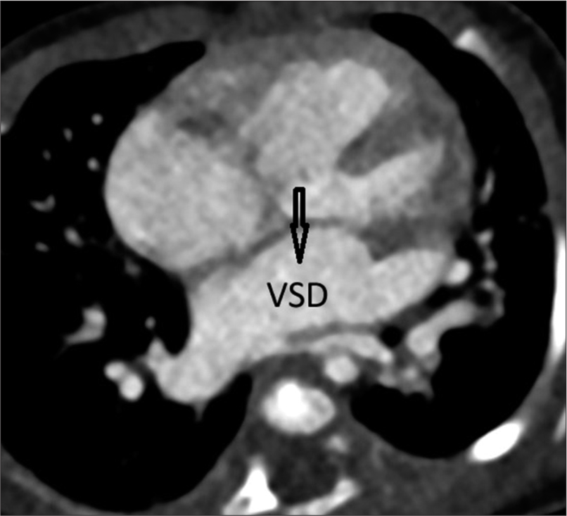 Partial Anomalous Pulmonary Venous Connection with Ventricular Septal Defect and Intact Atrial Septum
