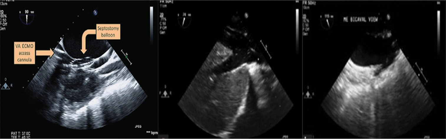 The Anesthesiologist as Extracorporeal Membrane Oxygenation Intensivist: Heralding a New Era?