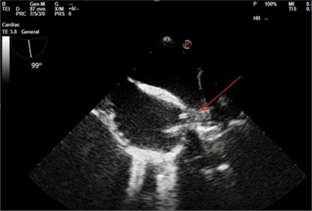 Role of Intra-operative Transesophageal Echocardiographic Examination in Inferior Vena Cava Tumor Thrombus Removal in a Case of Renal Ewing’s Sarcoma