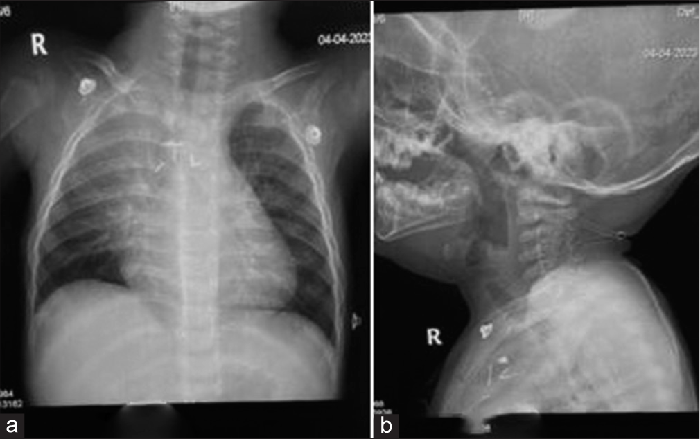 Shared Airway for Tracheal Resection and Anastomosis in a Patient with Severe Subglottic Stenosis after Intra-cardiac Repair for Tetralogy of Fallot