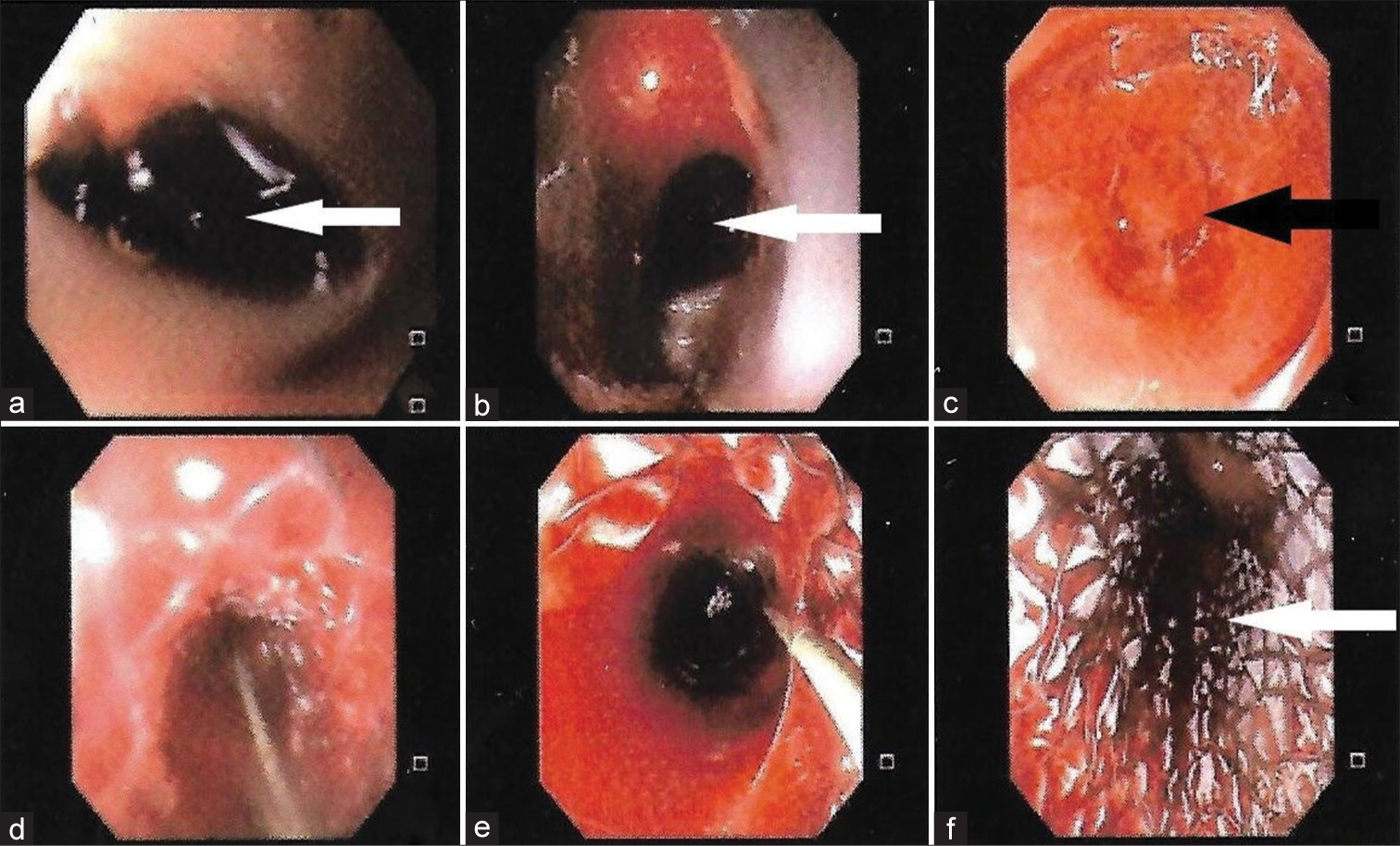 Transesophageal Echocardiography Probe-induced Esophageal Perforation