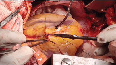 Coronary Revascularization following Failed Multiple Percutaneous Coronary Intravascular Stents