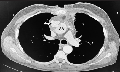 Mycotic Pseudoaneurysm of the Ascending Aorta following Coronary Artery Bypass Graft Surgery