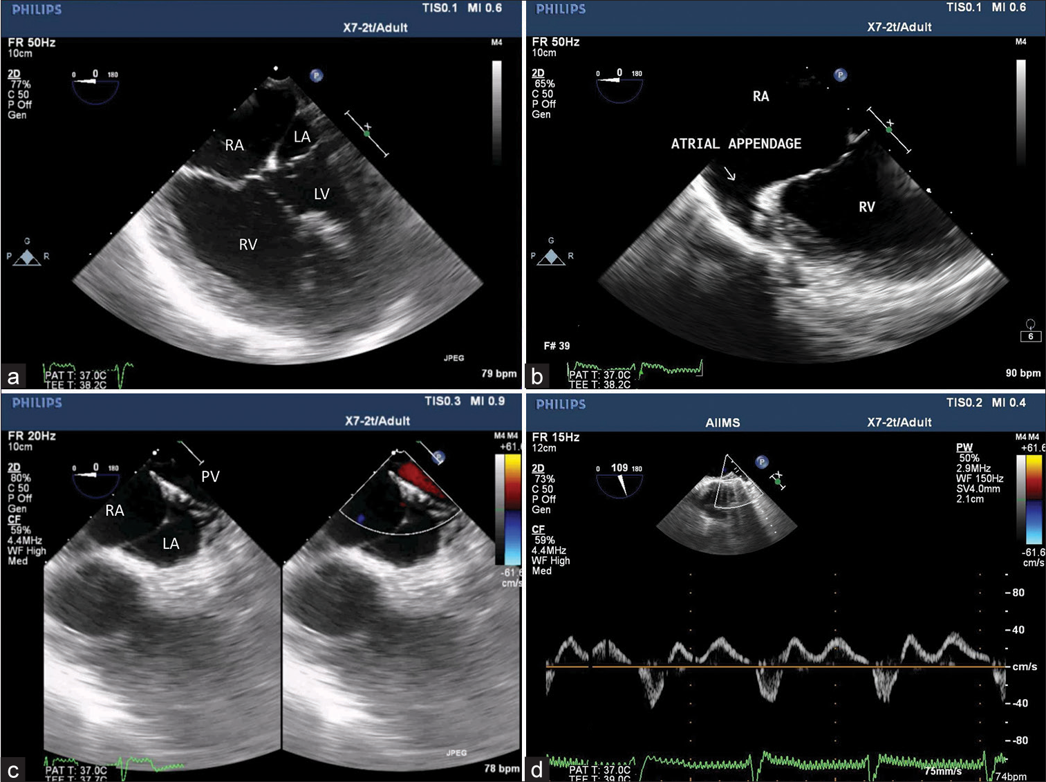 Transesophageal Echocardiographic Assessment of Single Ventricle Physiology with Interrupted Inferior Vena Cava in a Case of Heterotaxy Syndrome Posted for Kawashima Procedure and Hepatic Vein Rerouting