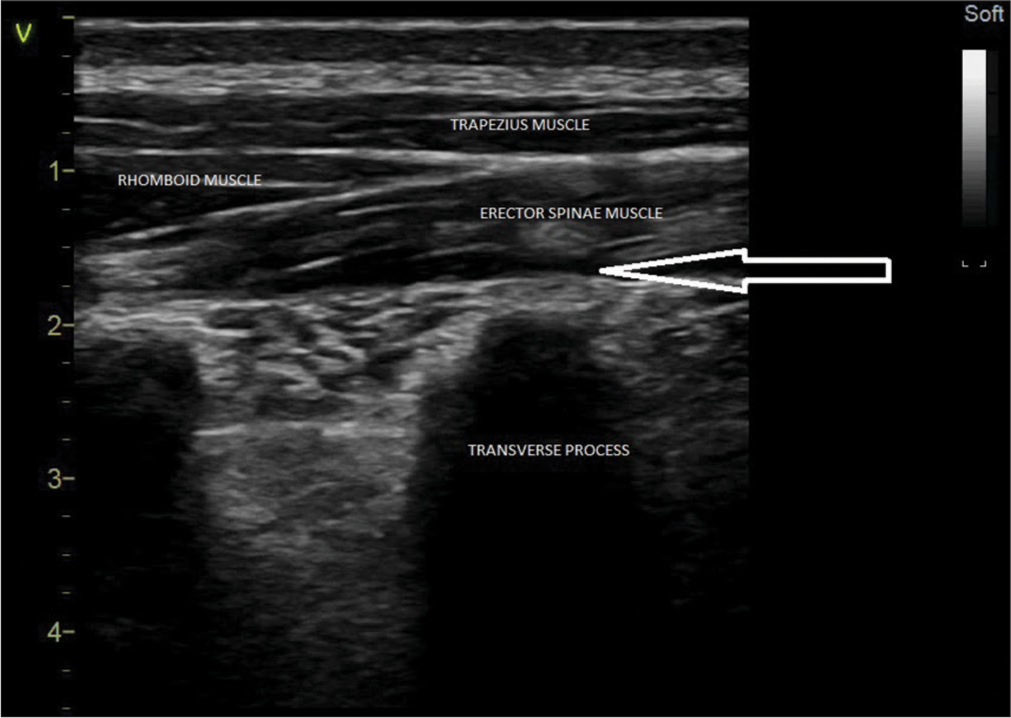 Continuous Erector Spinae Plane Block in Patients with Failed Epidural