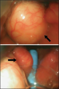 A Rare Case of Unanticipated Difficult Intubation Due to a Vallecular Cyst