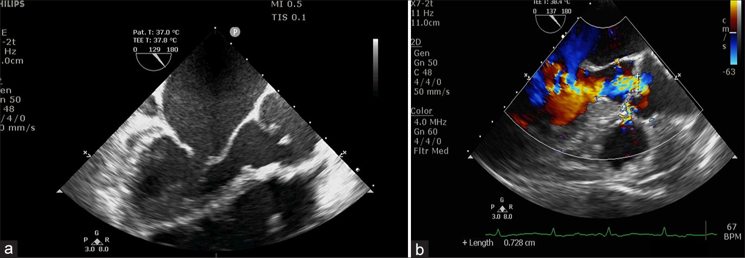 Quadruple Valve Replacement for Congenital and Rheumatic Valvular Heart Disease
