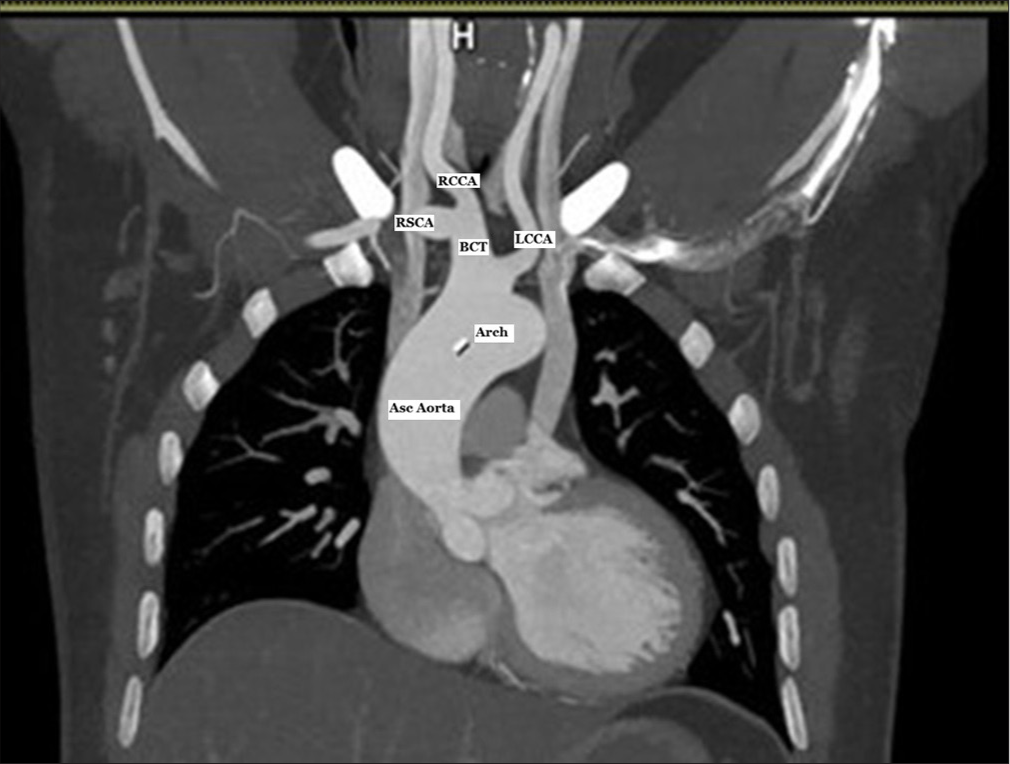 Bovine Aortic Arch: Implications during Cardiac Surgery