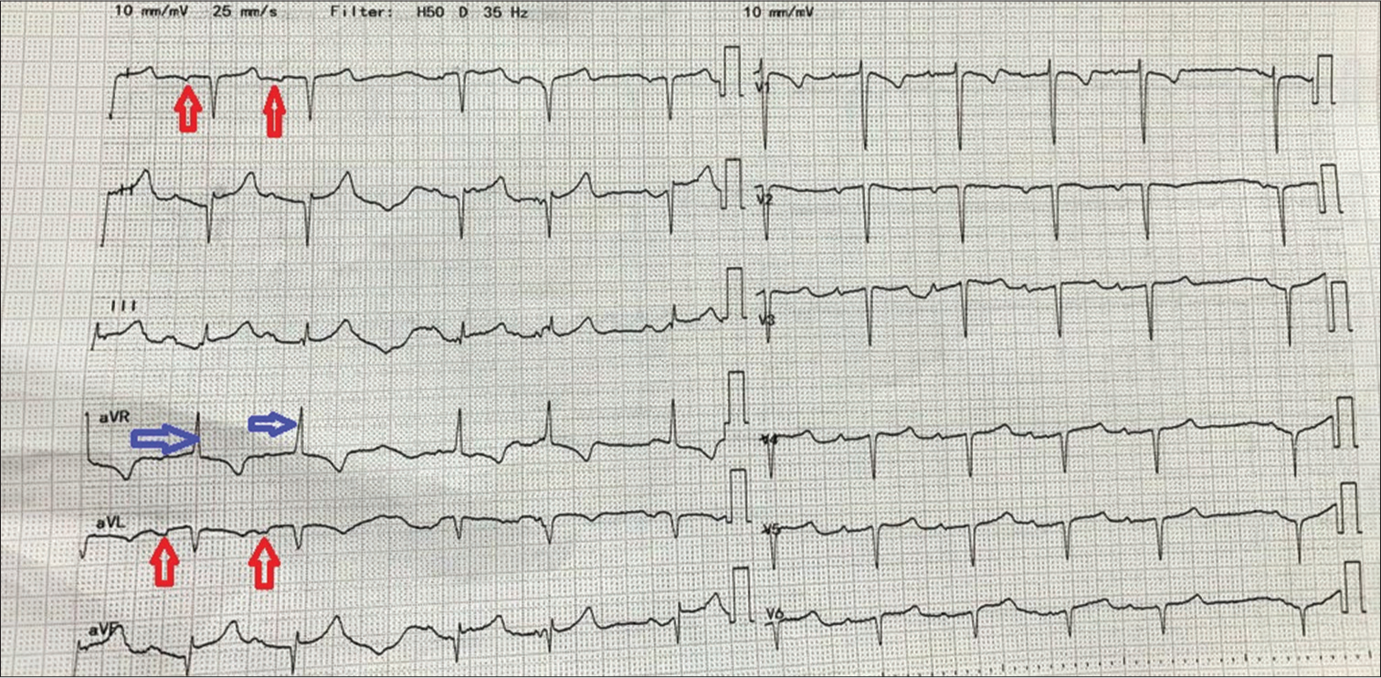 Dextrocardia with Atrial Septal Defect: Interesting Echocardiography Images