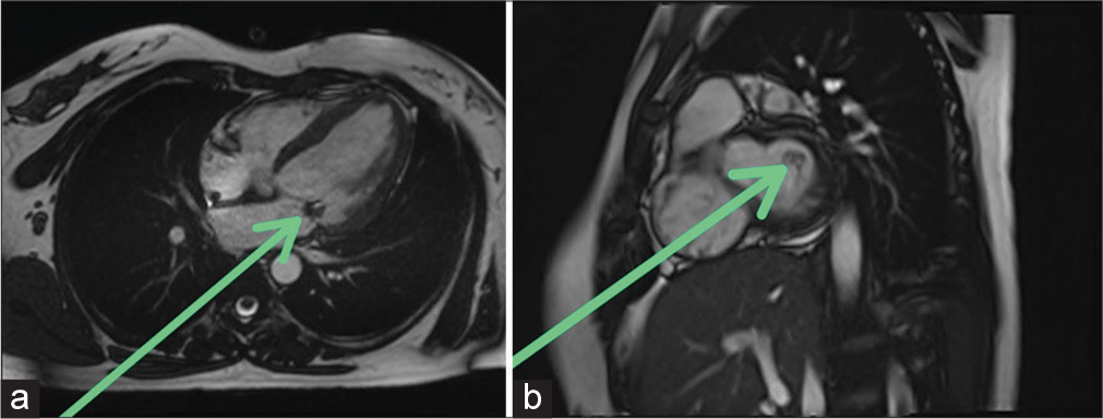 Libman-Sacks Endocarditis: A Silent Threat Unveiled by Stroke in a Young Female with Antiphospholipid Antibody Syndrome – A Case Report and Review of Literature