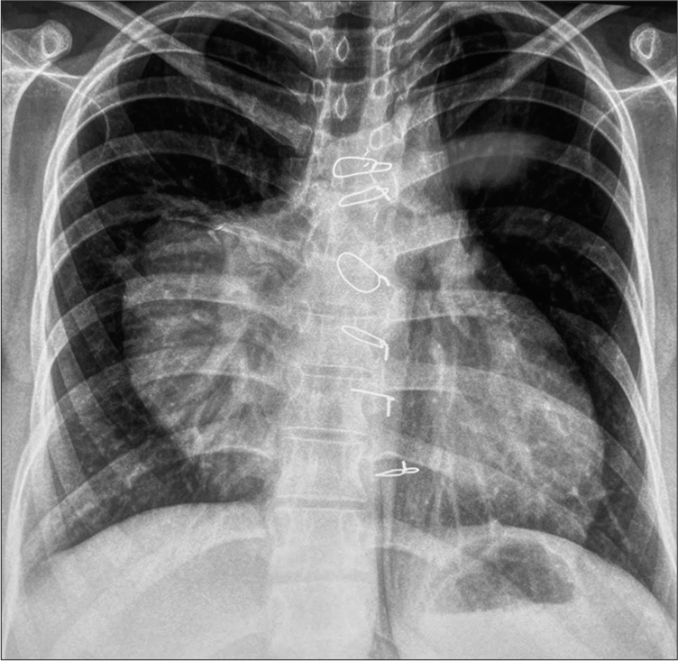 Eroding Pseudoaneurysm of Ascending Aorta