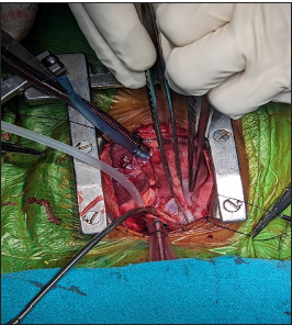 Total Anomalous Pulmonary Venous Connection with Right Pulmonary Artery Stenosis