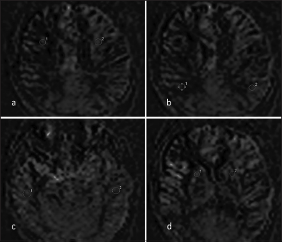 Superficial temporal artery-middle cerebral artery bypass signal intensity in time of flight magnetic resonance angiography as a marker of cerebral perfusion after revascularization procedure in moyamoya disease patients