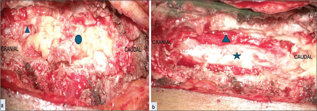 Thoracic hypertrophied ligamentum flavum: A retrospective study of pre-operative factors and surgical outcome