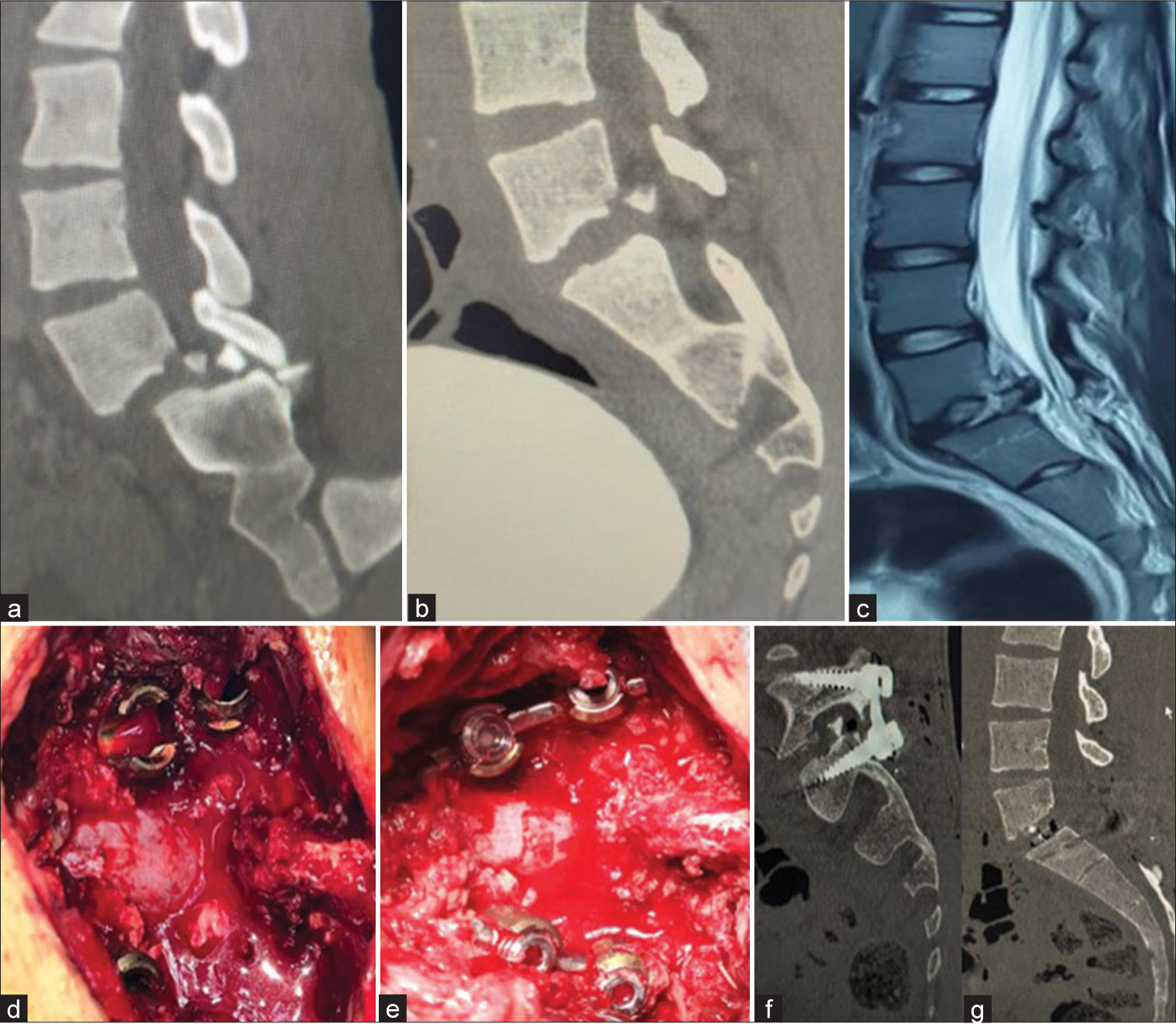 Traumatic lumbar spondylolisthesis: A case report and review of literature