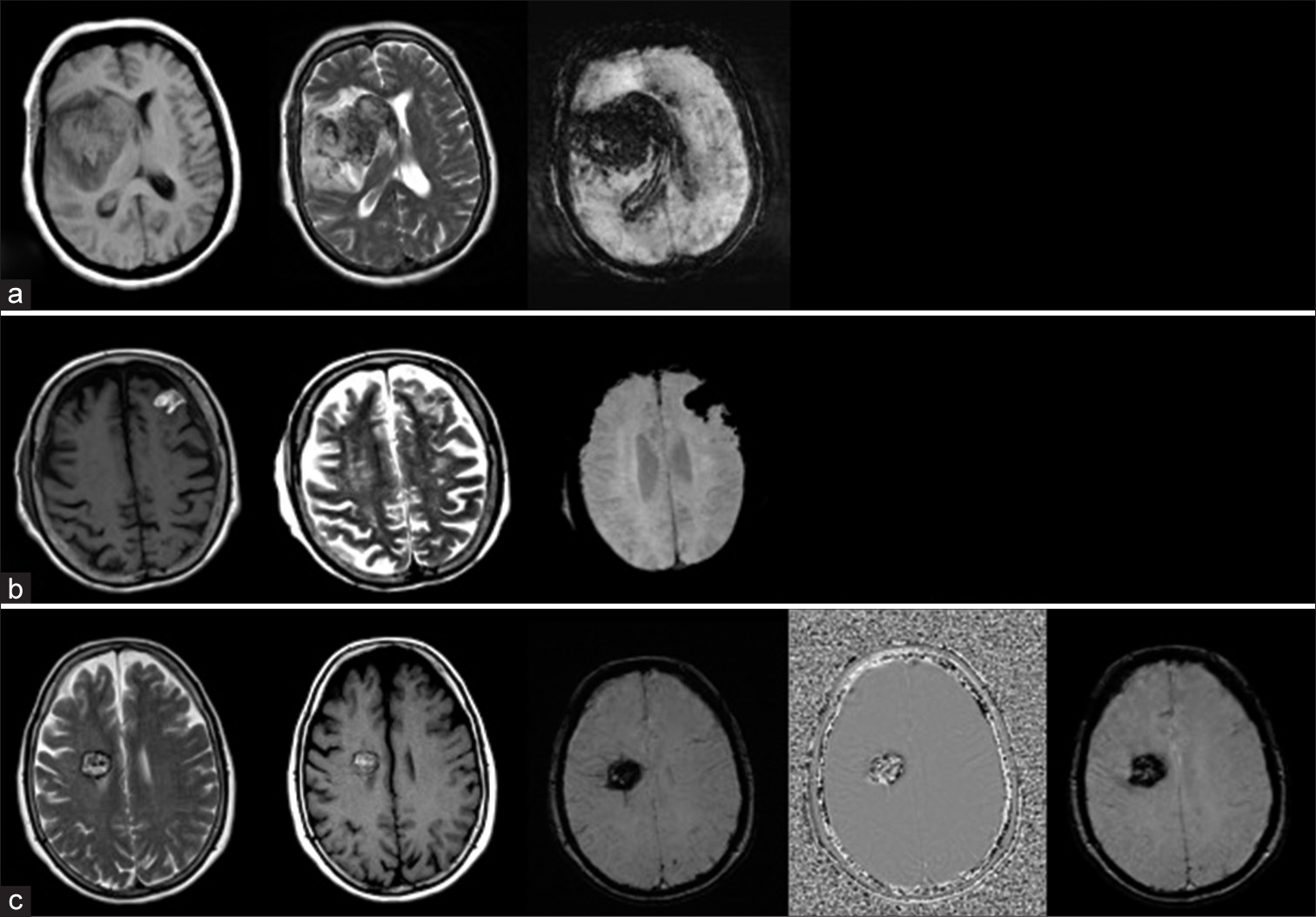 Cerebral microbleeds: Causes, clinical relevance, and imaging approach – A narrative review