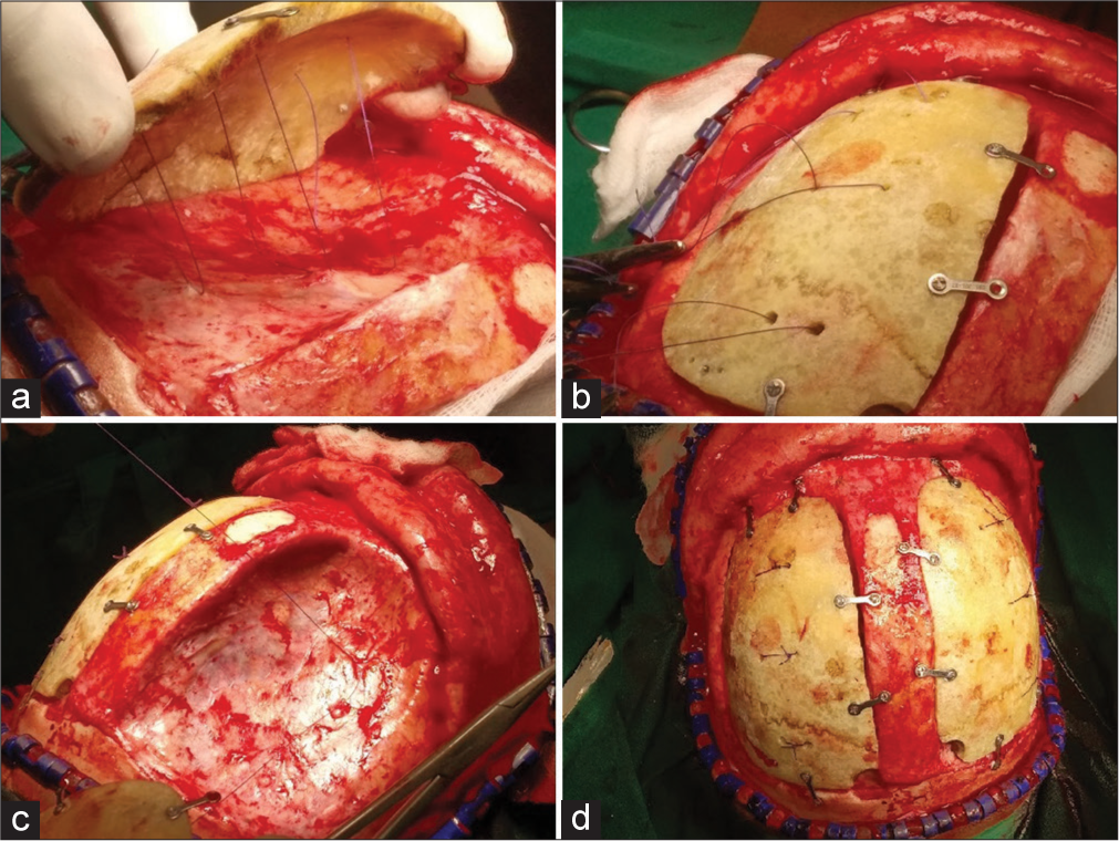 Pitching for the hitch: Neodural tenting sutures to prevent post-cranioplasty collection in a sunken craniectomy site