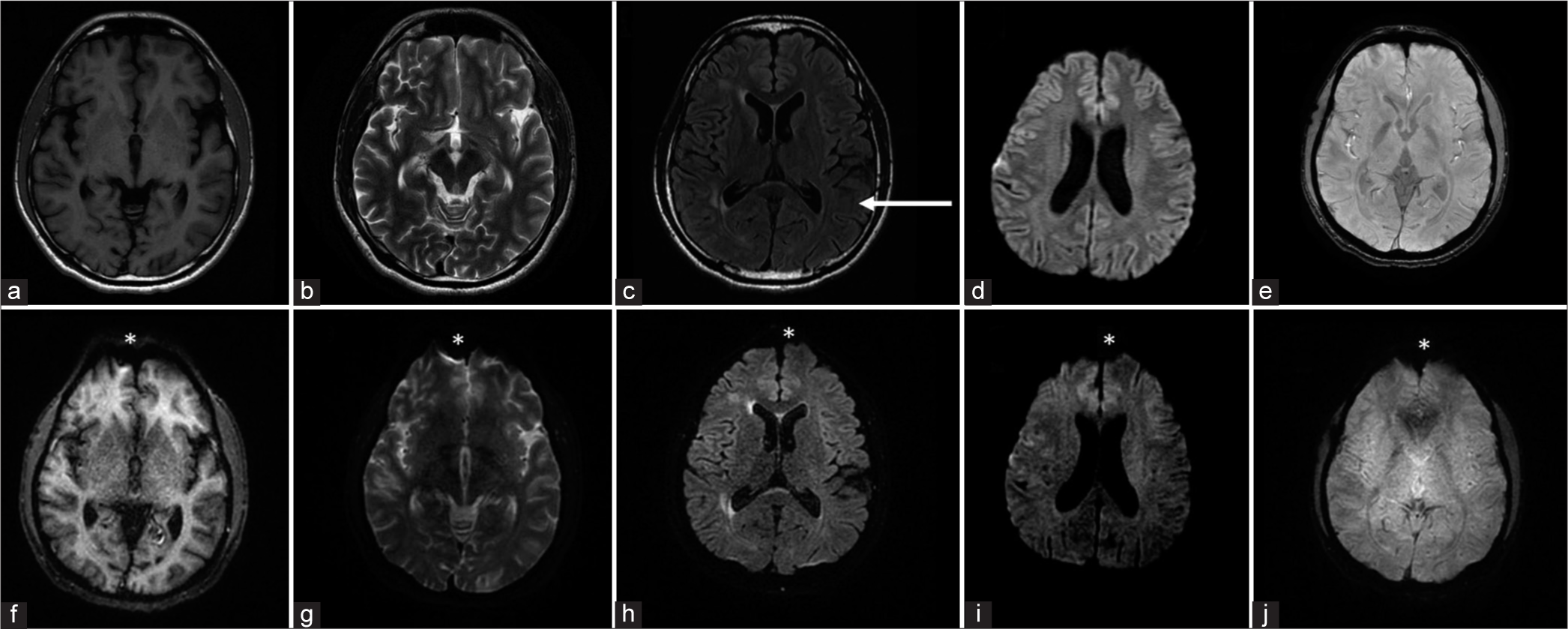Multi-contrast echo-planar imaging sequence (Echo-planar imaging mix) in clinical situations demanding faster MRI-brain scans