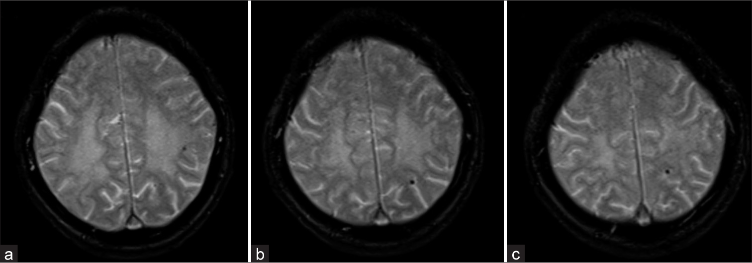 Clinicoradiological features of cerebral microbleeds diagnosed on magnetic resonance neuroimaging