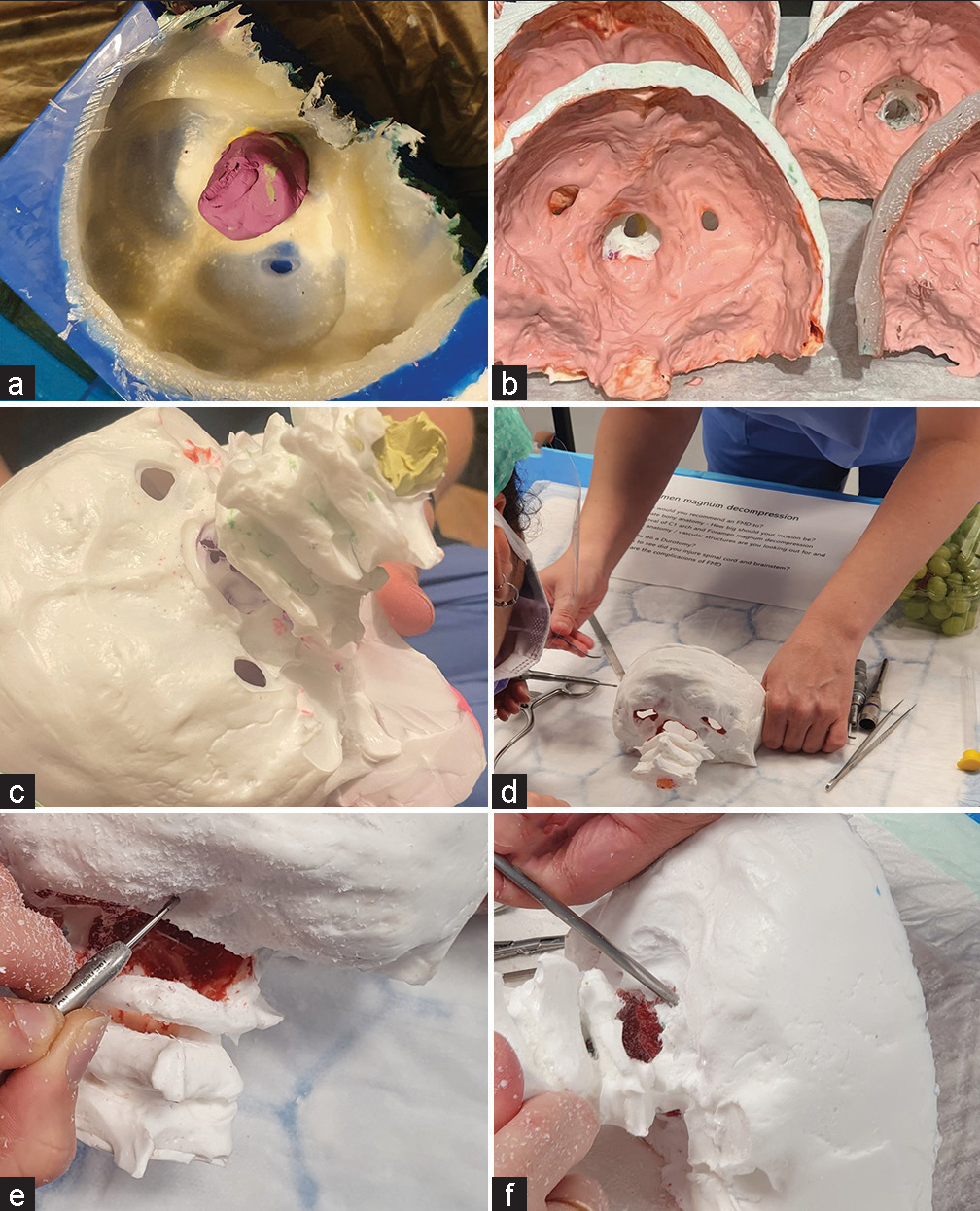 An inexpensive foramen magnum decompression training tool: Feasibility and validation study