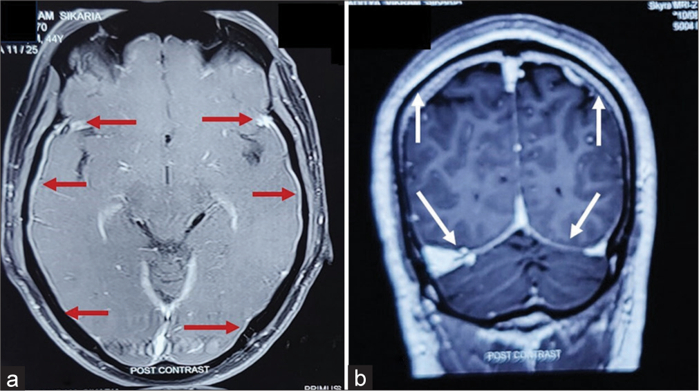 Sphenopalatine ganglion block for the treatment of spontaneous intracranial hypotension without demonstrable cerebrospinal fluid leak: A report of two cases
