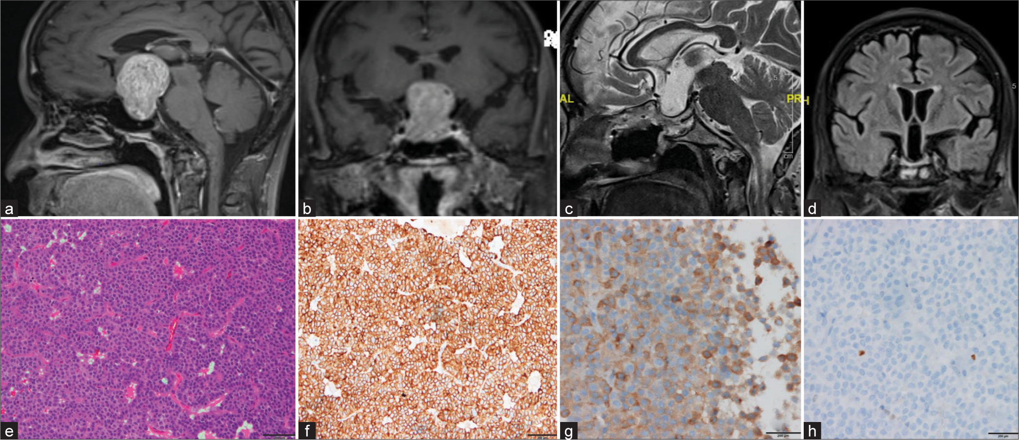 Reversible dementia in a case of functional gonadotropin-secreting pituitary adenoma: Different shades of gray