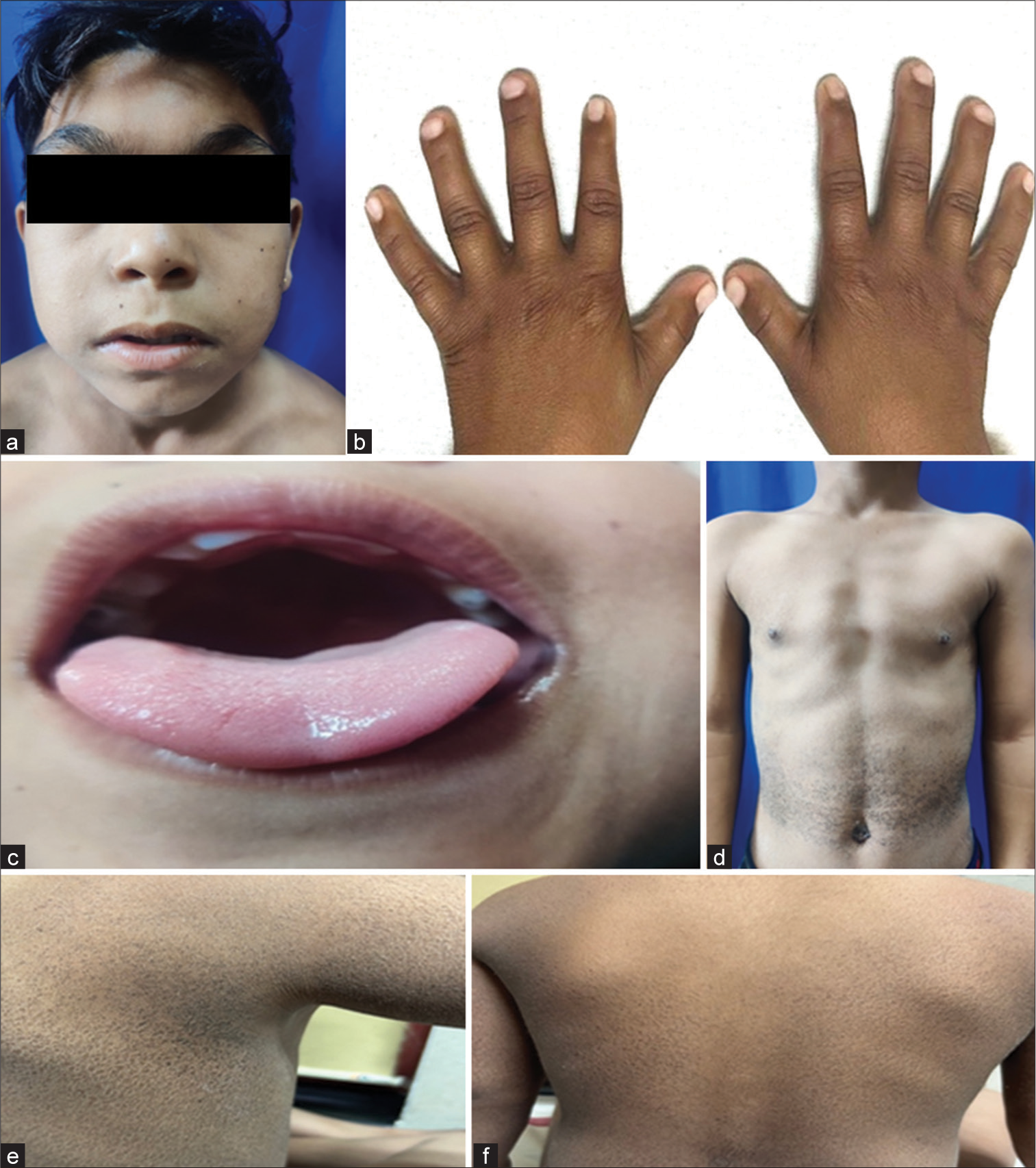 Chromosome Xp22.3 deletion syndrome with X-linked ichthyosis, Kallmann syndrome, short stature, generalized epilepsy, hearing loss, attention deficit hyperactivity disorder, and intellectual disability – A rare report with review of literature